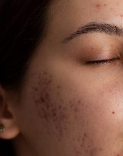 acne e1748991047148